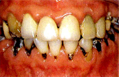 大人のムシ歯例1