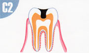 虫歯C2