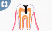 虫歯C3