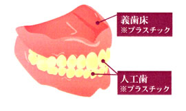 総入れ歯（総義歯）