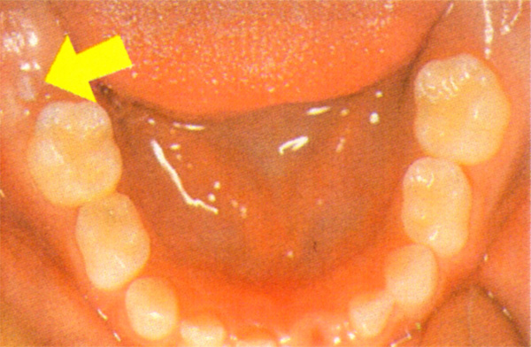 生えかけている６才臼歯の様子