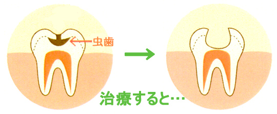 歯周病の様子