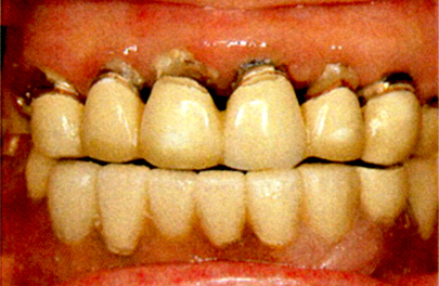 大人のムシ歯例2