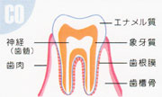 虫歯C0