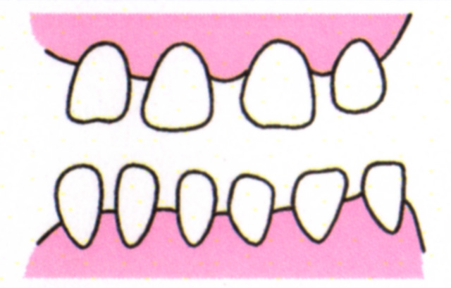 空隙歯列