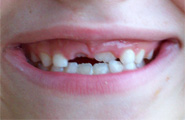 乳歯がむし歯になると、そこに生え替わってくる永久歯もむし歯になりやすくなります