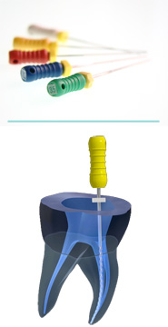 歯に穴を開ける際の様子と、その器具