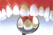 虫歯治療例
